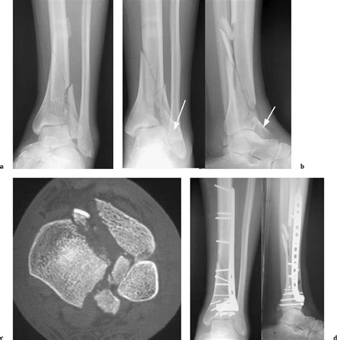 Distal Tibia Fracture