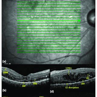 OCT biomarkers in diabetic macular edema (DME) eyes. (a) A... | Download Scientific Diagram