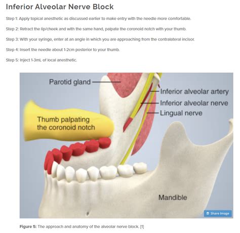 Modifications Of Inferior Alveolar Nerve Block Techni - vrogue.co