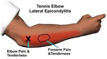 Elbow and wrist pain - How Physio Treatment helps | Adelaide