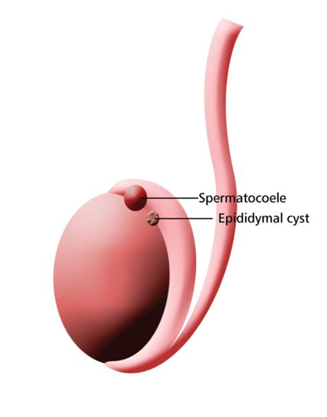 Spermatocele - Causes, Symptoms, Treatment and Pictures