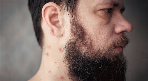 Pimple on Neck: Causes and How to Treat Them | Healthnews