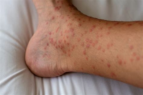 Papular Urticaria: A Guide to This Severe Bug Bite Reaction | The Healthy