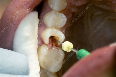 Root canal dental surgery - Stock Image C029/0466 - Science Photo Library