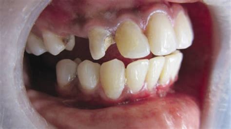 Preoperative view of right maxillary canine | Download Scientific Diagram