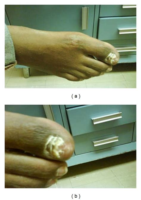 Resolution of all lesions after 6 cycles of CHOP chemotherapy ...