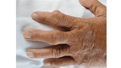 9 Pictures of the Gout: Symptoms, Food to avoid, other tips : Physiosunit