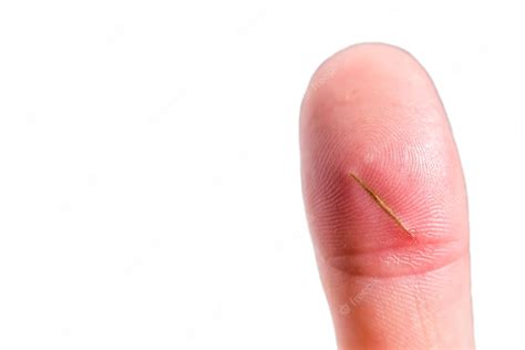 Premium Photo | Close up of finger with splinter infection finger injury copy spacexa