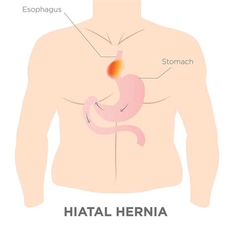 Hiatal Hernia Treatment | Alternative DrMCare