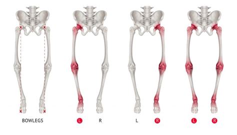 Facts About Varus Deformity - Facty Health