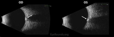 Optic Disc Drusen. EyeRounds.org: Online Ophthalmic Atlas