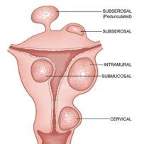 What are Uterine Fibroids? | Symptoms & Treatment | Types of Fibroids