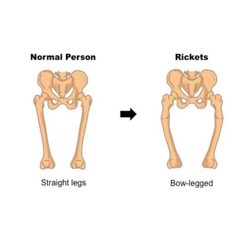 Rickets Disease Symptoms