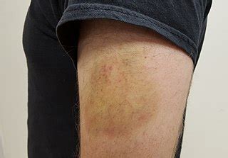 File:Upper Arm Bruise.jpg - Wikimedia Commons