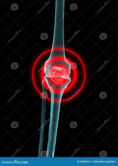 Knee inflammation stock illustration. Illustration of spine - 3658491