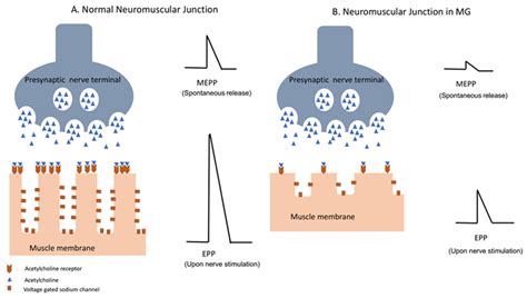 JCM | Free Full-Text | Myasthenia Gravis: Epidemiology, Pathophysiology ...