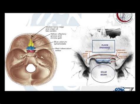 Brain Tumours (33): Meningiomas (7): Tuberculum Sellae/Planum ...