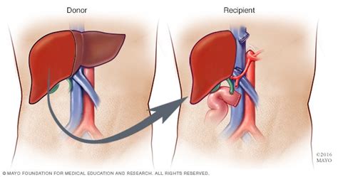 Liver transplant - Mayo Clinic