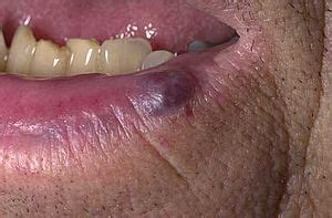 Blue lump on your lip- Venous Lake