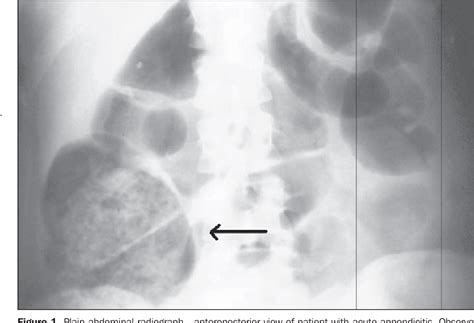 Figure 1 from RADIOGRAPHIC IMAGE OF FECAL LOADING IN THE CECUM AS A DIAGNOSTIC SIGN OF ACUTE ...