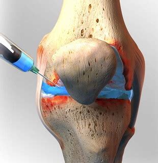 Synvisc Knee Injections: Indications & Side Effects - Knee Pain Exp