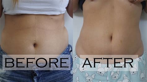 Froze My Belly Fat Using Coolsculpting - See The Before & After! - YouTube