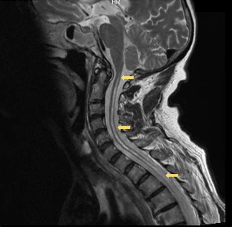 Cervical spinal cord MRI with syrin. | Download Scientific Diagram