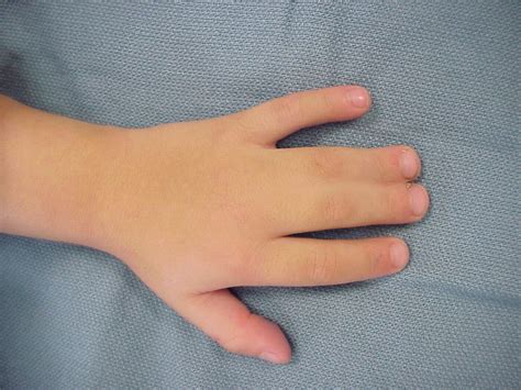 Birth: Syndactyly release incision planning potential pitfall