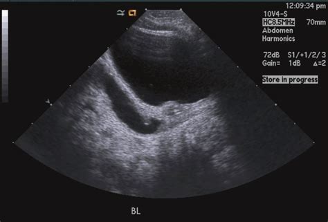 Distal Ureter Ultrasound