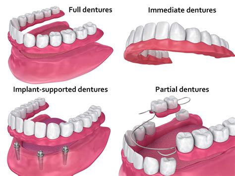 Dentures Kansas City, MO - Blue Springs, MO - Matthew A. Turner DDS, PC