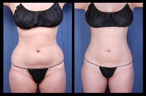 Liposuction Omaha | Imagen Body Sculpting & Liposculpture