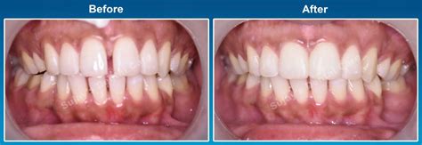 Midline diastema correction - Sujay's Dental Care