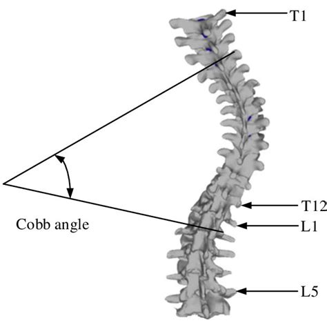 Schematic diagram of Cobb angle [18] . | Download Scientific Diagram