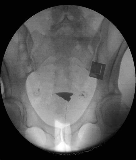 Hysterosalpingogram procedure, uses & hysterosalpingogram side effects