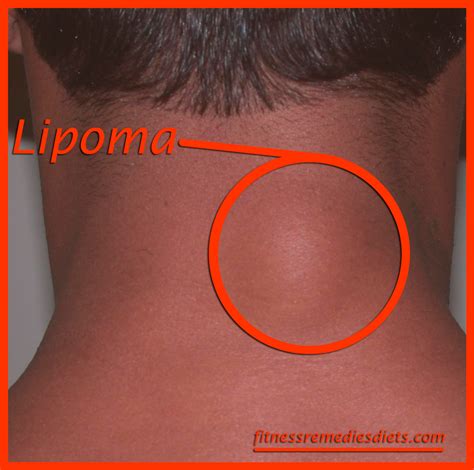 What Is A Lipoma? Lipoma Treatment. How To Remove A Lipoma? | Fitness Remedies Diets