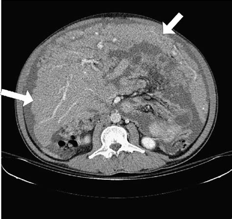 Computed tomography scan of the abdomen shows omental cake (arrows). | Download Scientific Diagram