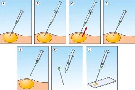 Fine Needle Aspiration (FNA) Cytology: A Tool For Quick Diagnosis