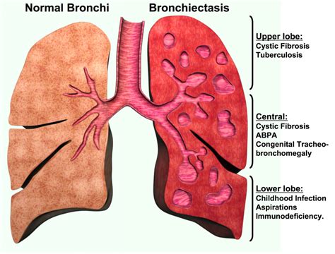 Bronchiectasis — Medlibes: Online Medical Library