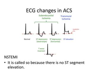 Ecg in acute coronary syndrome and acute care | PPT