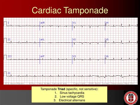 Cardiac Tamponade Ecg Changes