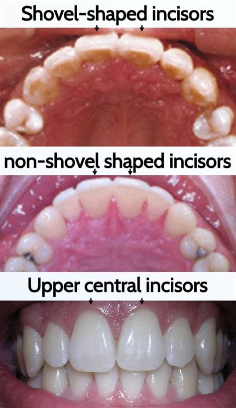 TIL that not everybody's incisors are curved on the back. "Shovel teeth" indicate an Asian or ...