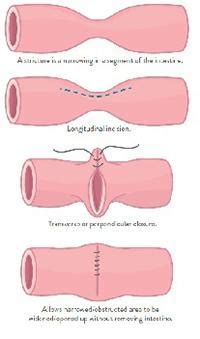 Strictureplasty | Crohn's & Colitis Foundation