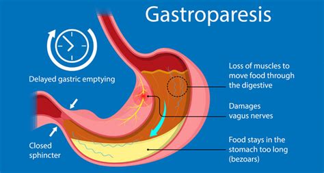 Do you have Bile Reflux? - Refluxgate