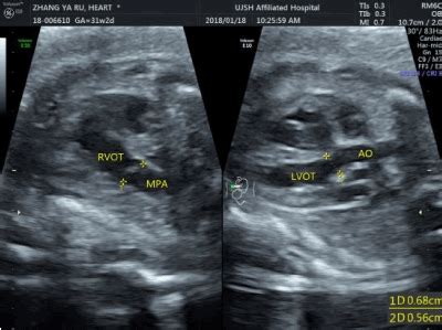 Fetal Lvot Ultrasound