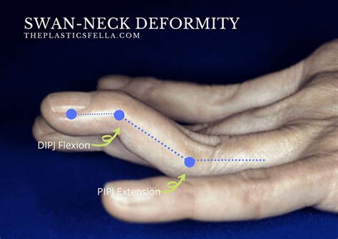 Swan Neck Deformity vs Boutonnières