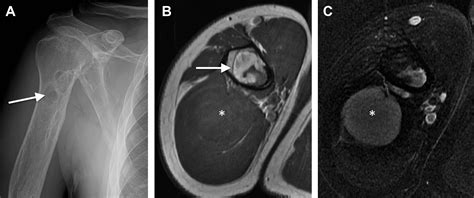 Shoulder Tumor/Tumor-Like Lesions - Magnetic Resonance Imaging Clinics