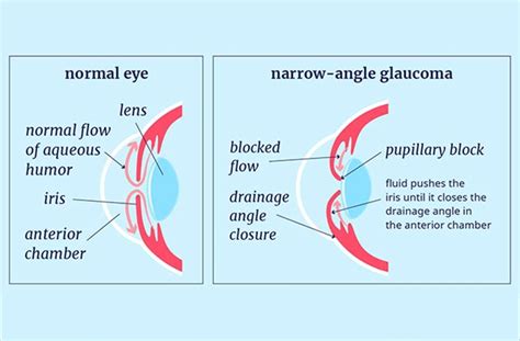 Angle Closure Glaucoma Vs Open Angle