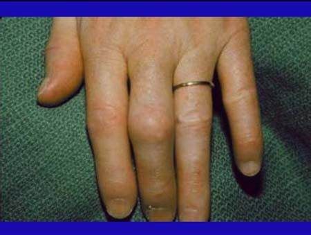 Woundbiotech - Wounds:Common and Uncommon - Scleroderma and Scleroderma ...