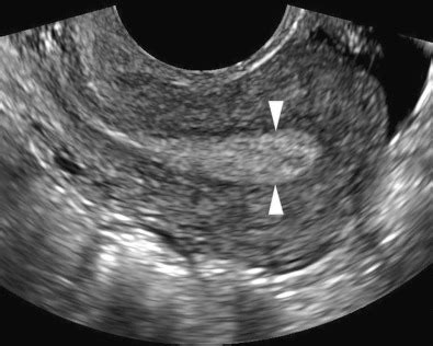 Abnormal Uterine Bleeding: The Role of Ultrasound | Obgyn Key