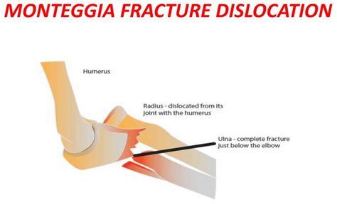 Monteggia fracture causes, types, symptoms, diagnosis, treatment & prognosis